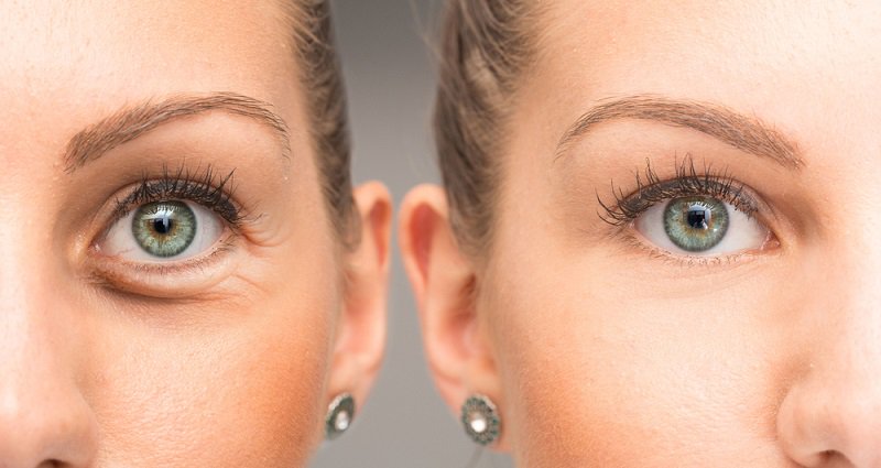 cum să eliminați ridurile de la colțurile ochilor