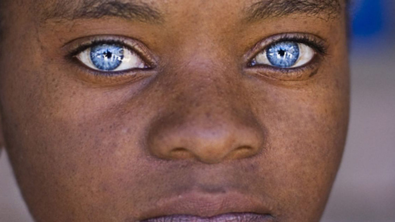 Boli genetice ale ochilor, Afectiunile ochiului: cauze, simptome si tratament